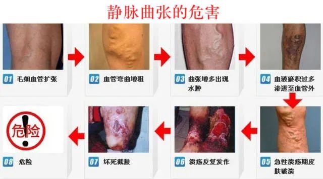静脉曲张：.jpg